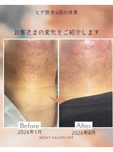 オフ(off)/ヒゲ脱毛