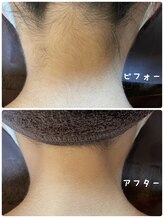 ゼロ(ZERO)/うなじ脱毛☆before&after