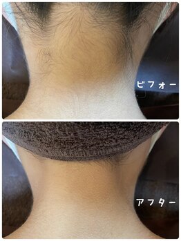 ゼロ(ZERO)/うなじ脱毛☆before&after