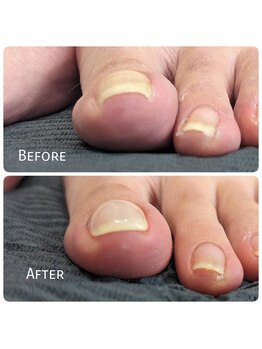 リエル(RIELE)/巻爪補正