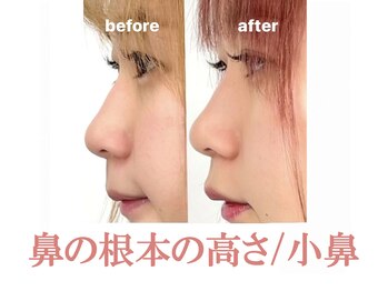 ラプリ 浜松店(Raplit)/ 隆鼻＋輪郭矯正40分10回