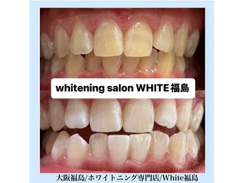 ホワイトニングサロン ホワイト(WHITE)/セルフホワイトニング/大阪/福島