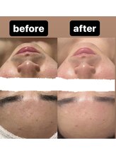 ミーナヴェル(Mi-Nabelle)/毛穴洗浄で毛穴レス×透明感UP！