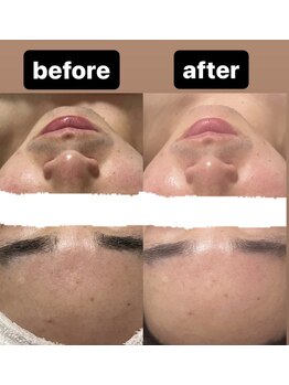 ミーナヴェル(Mi-Nabelle)/毛穴洗浄で毛穴レス×透明感UP！