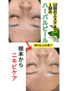 エミナル(EMINARU)/ハーバルピール