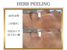 ロージー(ROSY)/ハーブピーリング/阿南/徳島