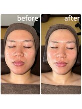 エヌ(N)/【光フォト】1回目の施術です★