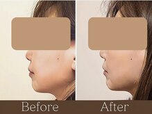 アントルーチェ 代々木上原(Entluce.)/頬下の重さが消えてEラインが◎