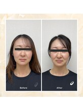 プレメ 人形町院(The Preme)/美容鍼　2回施術後