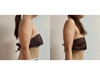 リュミエール(Lumiere)/二の腕スッキリ