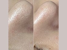セリジェ 青山(Cerisier)/セリジェは毛穴プロが揃うサロン