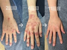 せせらぎ鍼灸院/皮膚のお悩み、ご相談ください