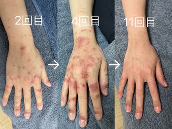 せせらぎ鍼灸院/皮膚のお悩み、ご相談ください