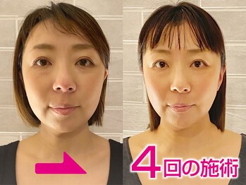 ネルジム 札幌店(NERU GYM)/1回目施術後→4回目施術後