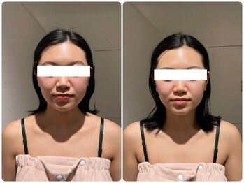 イデアルミー 大宮店(イデアルMe)/レモンボトル＆ララピール