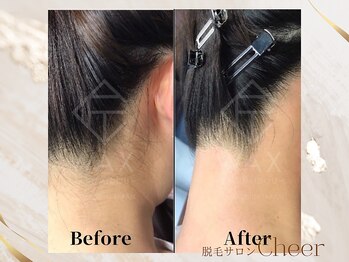 チア(Cheer)/うなじワックス