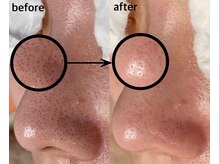 毛穴専科/韓国肌管理◇ 学割u24あり
