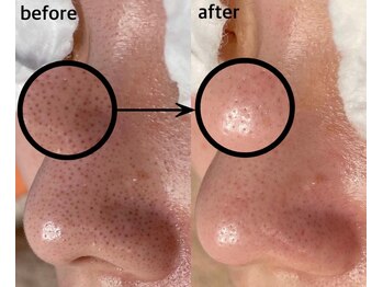 毛穴専科/韓国肌管理◇ 学割u24あり