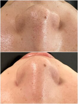 マヴィ 香里園店(MavY.)/毛穴ゼロ☆ポテンツ級