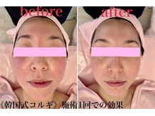 小顔矯正 アメリ ビューティーサロン(Ameri beauty salon)/韓国式コルギ小顔コース