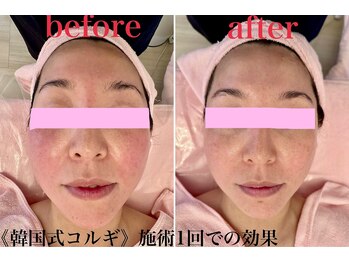 小顔矯正 アメリ ビューティーサロン(Ameri beauty salon)/韓国式コルギ小顔コース