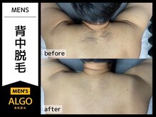 アルゴ 福井店(ALGO)/30代男性 10回目 メンズ背中脱毛
