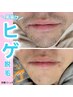 【男性限定】最新光脱毛☆ヒゲ