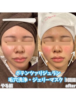 ビアル(VIALU)/毛穴レス美肌へ!3回目でこの変化