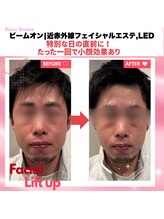 ビジュボーテ(Bijou Beaute)/近赤外線フェイシャルエステ,LED
