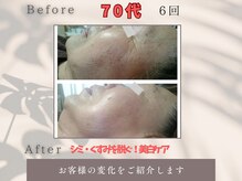 トータルビューティー雅/70代お客様肌若々しくシワに注目