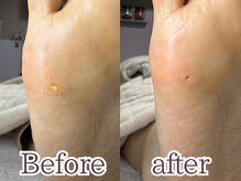 ポドロ(PoDoLo)/【小指の下の魚の目】角質梅田