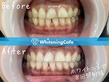 ホワイトニングカフェ 藤が丘店(WhiteningCafe)/ホワイトニングビフォーアフター