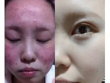 リベル(ReBelle.)/元々血まみれの肌でした。