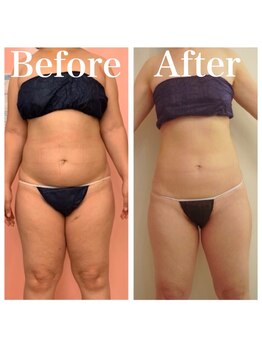 トータルビューティサロン クイーン(Queen)/たるんだお腹の皮膚もお任せ!