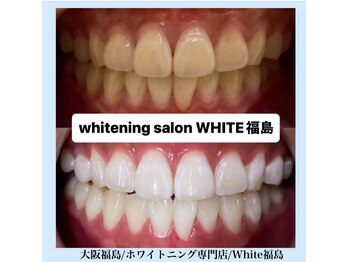 ホワイトニングサロン ホワイト(WHITE)/セルフホワイトニング/大阪/福島