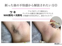 アルゴ 吹田千里山駅前店(ALGO)/ALGO式WAX脱毛＋光脱毛