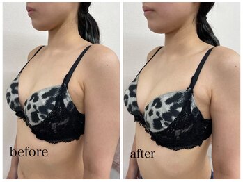 ルミエール(Lumiere)/【倉敷市】バストアップ施術事例