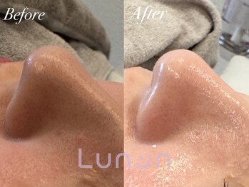 ルノン(Lunon)/毛穴洗浄ハイドロ