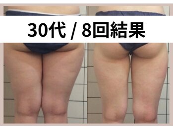 リストアミー(Restore me)/頑固なデコボコ脂肪もスッキリ♪