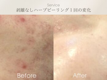 フェイシャルサロン ベルダ(BELDA)/【ニキビケアBefore After 】