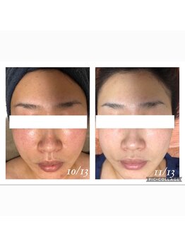 オアジスパ(Oasi Spa)/DTなしピーリング１回