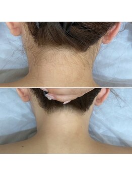 インベスト(INVEST)/うなじ脱毛