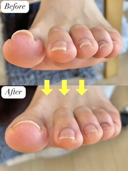 ニコワイズネイル(Nico Y's Nail)/【巻き爪緩和コース】