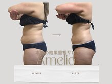 アメリオ(Amelio)の雰囲気（オールハンド全身+キャビ90分3回でこの結果♪）