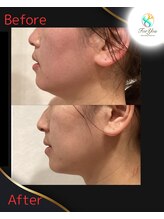 フォーユー 飯能店(Foryou)/レモンボトル3回　衝撃変化！！