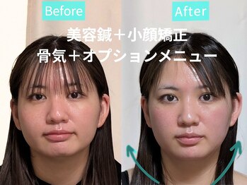 カンワ美容鍼灸院(KANWA美容鍼灸院)/30代女性ラジオ波美容鍼コルギ