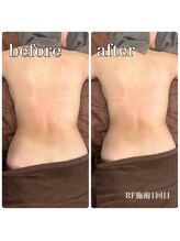 サロンドルクリア(Salon de LUCULIA)/エステ＃ラジオ波脂肪燃焼コース