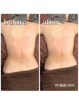 サロンドルクリア(Salon de LUCULIA)/エステ＃ラジオ波脂肪燃焼コース