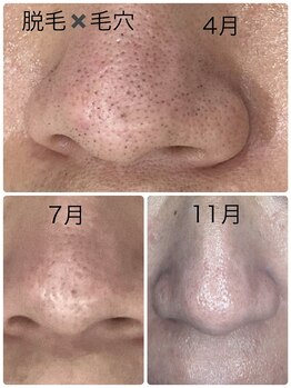 ルミネル 名古屋新栄(Luminelle)/脱毛・毛穴