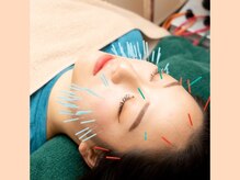 健志接骨院/大人気のマロン鍼でハリ艶肌ケア